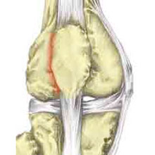 Patellofemoral Pain Syndrome