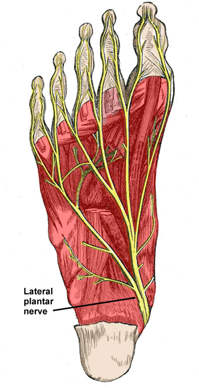 Medial Plantar Nerve Neuroma