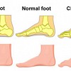 Overpronation | Foot Biomechanics Explained