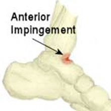 Ankle Impingement