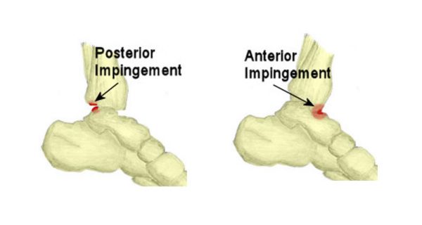 Ankle impingement