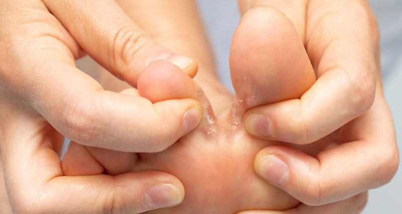 Foot | Tinea Pedis - Symptoms, Causes 