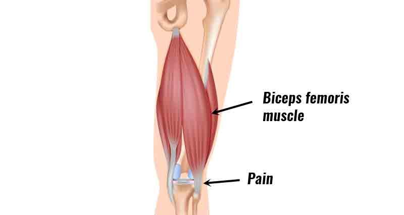 Biceps femoris tendinopathy