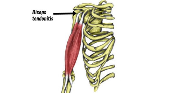 Long head of biceps muscle