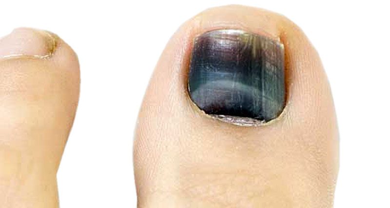 Toenail Injury Information  Foot  Ankle Specialists