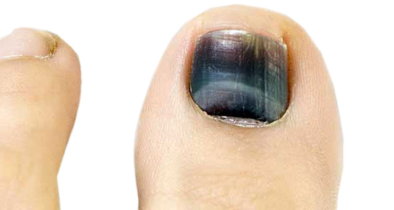 Share 117+ nail black spot symptoms super hot