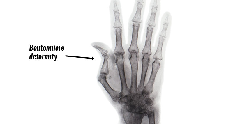 boutonniere deformity