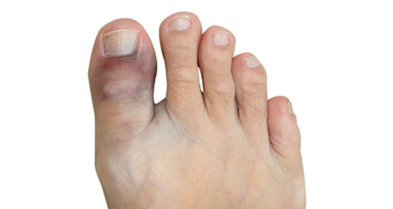 Broken toe