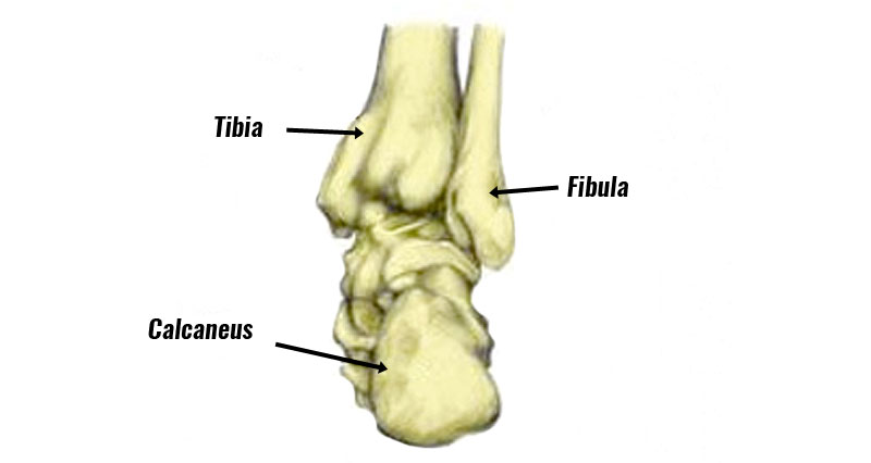 Calcaneal fracture