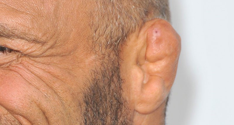 Cauliflower ear