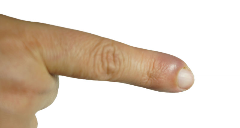 Finger felon cellulitis