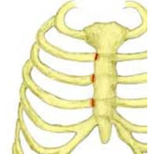 Costochondritis