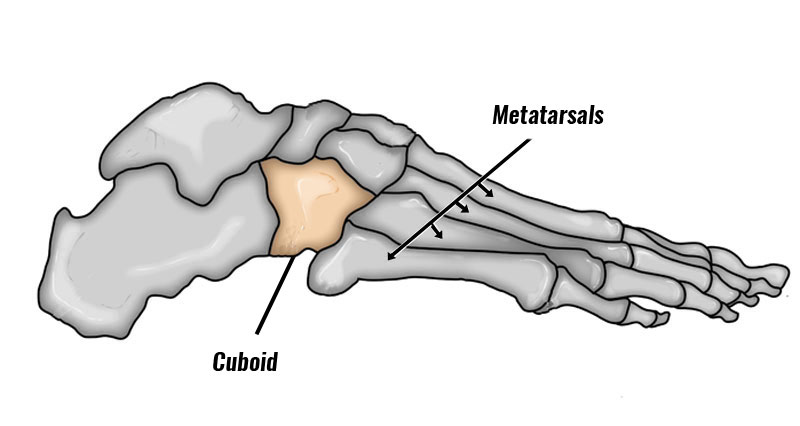 Cuboid syndrome