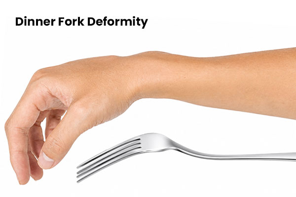 dinner-fork-deformity600