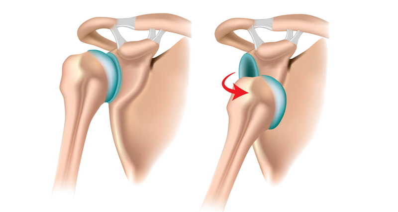 Dislocated shoulder