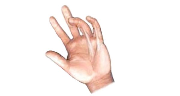 Dupuytrens contracture