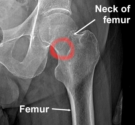 Stress fracture neck of femur