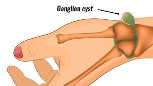 Wrist ganglion cyst