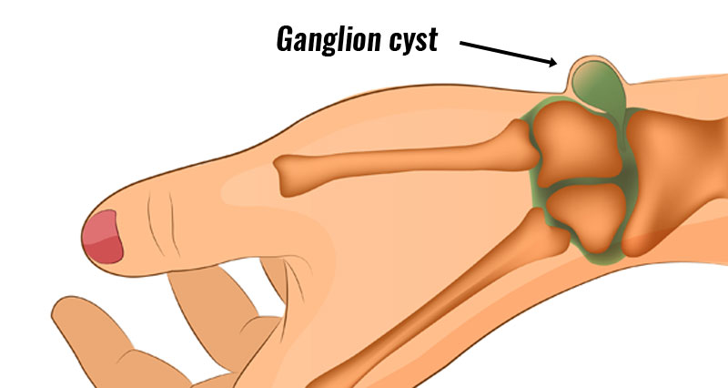 Wrist ganglion cyst