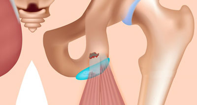 Pelvic avulsion strain fracture