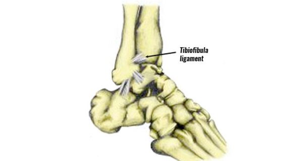 High ankle sprain