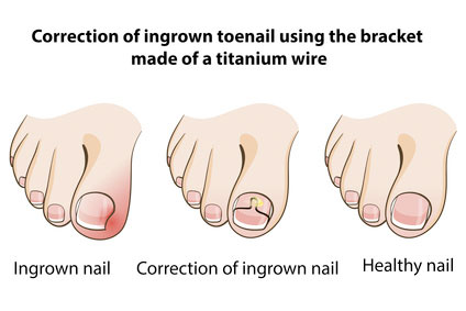 ingrown toenail treatment