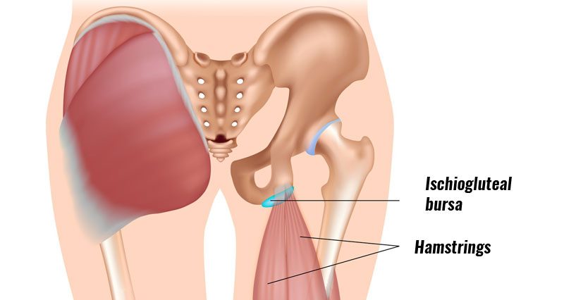 Ischiogluteal bursitis