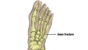 Jones fracture