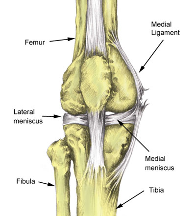 Knee joint medial meniscus tear