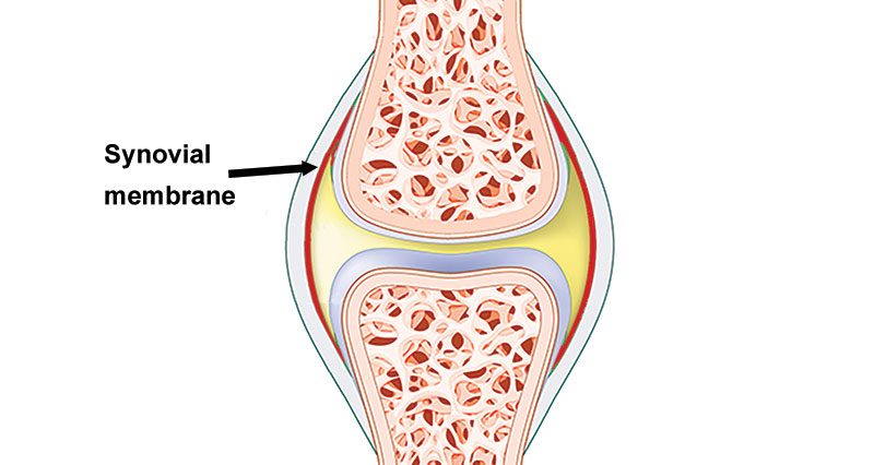 Knee synovitis