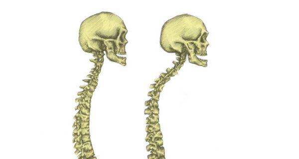 Kyphosis
