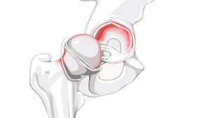 Labral tear of the hip