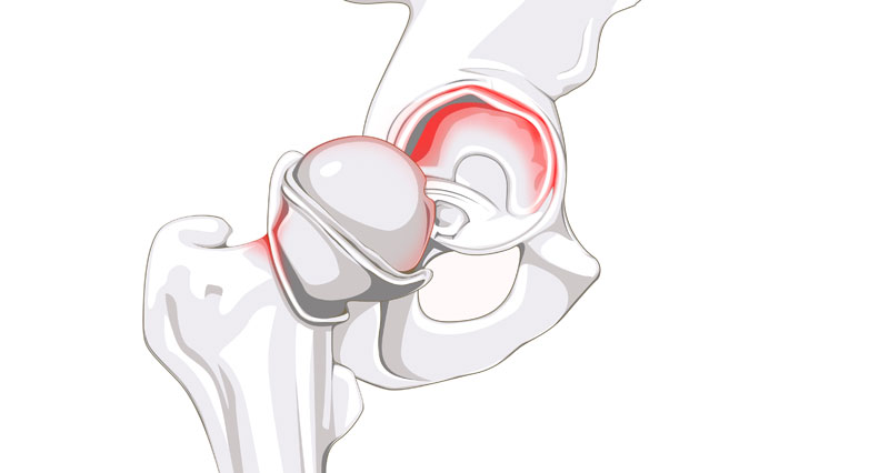 Labral tear of the hip