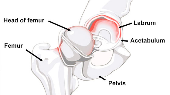 labral tear