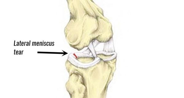 Lateral knee meniscus tear