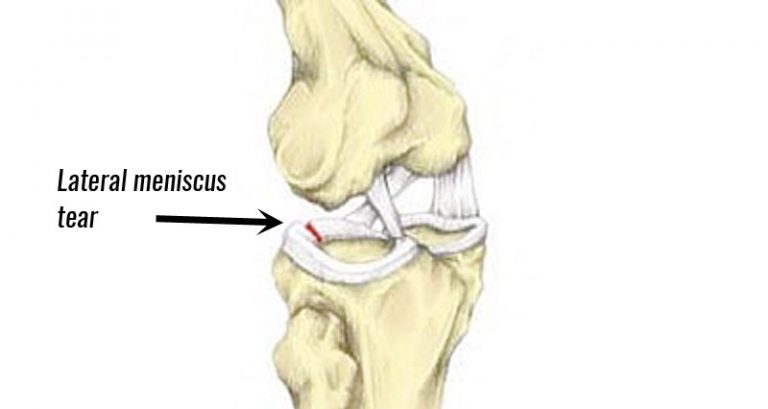 Outside knee pain Archives - Sportsinjuryclinic.net