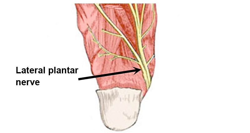 Lateral plantar nerve entrapment