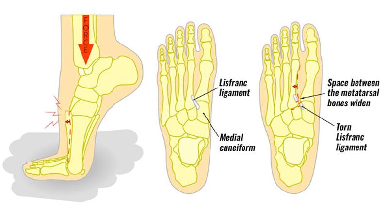 lisfranc injury causes)