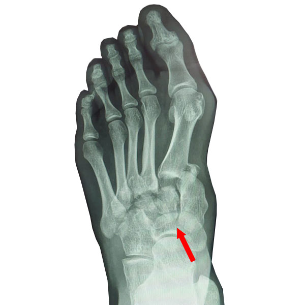 Lisfranc injury X ray