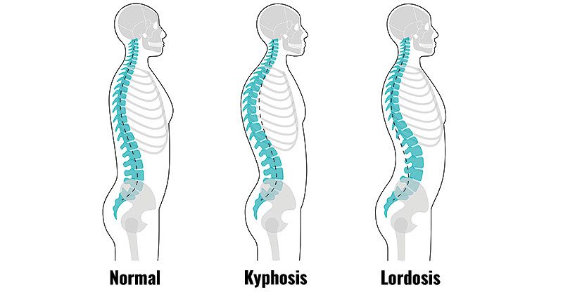 Hyperlordisis and kyphosis