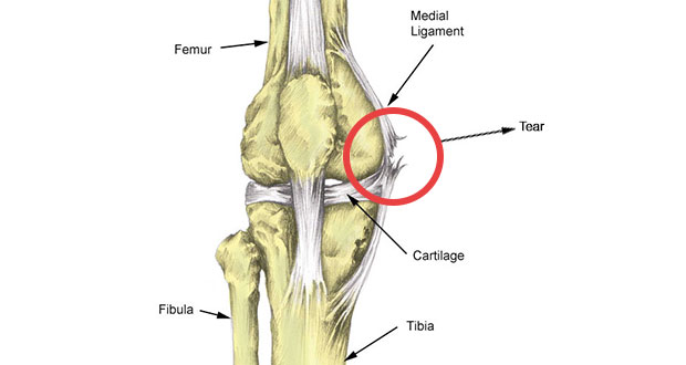 Medial knee ligament sprain