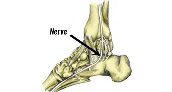 Medial calcaneal nerve