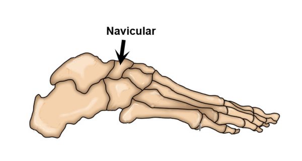 Navicular stress fracture