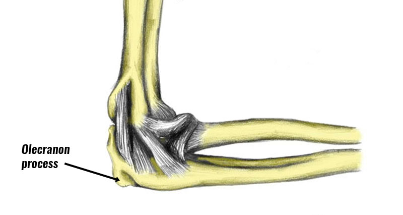 Olecranon fracture