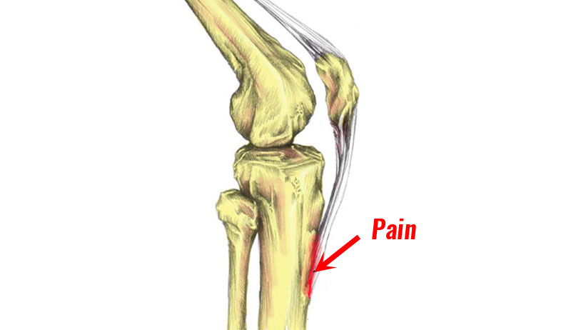 Osgood Schlatter Disease How To Treat And Manage It In Adolescents