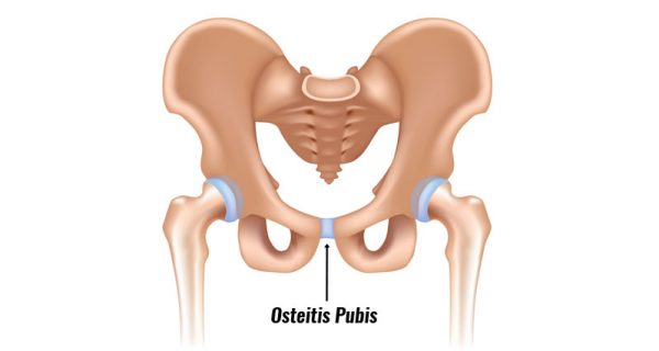 Osteitis Pubis