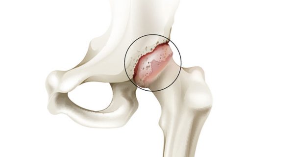 Osteoarthritis of the hip