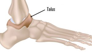Osteochondral lesions of the talus