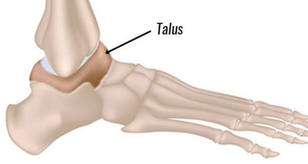 Osteochondral lesions of the talus
