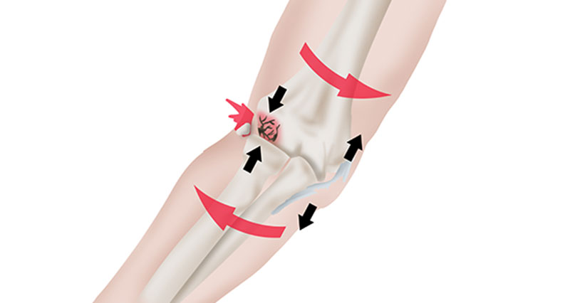 Osteochondritis dissecans in the elbow